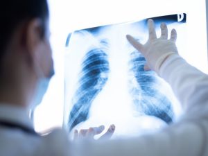 'Ciğerlerde kalan Covid-19 nodülleri akciğer kanseri başlangıcı olabilir'